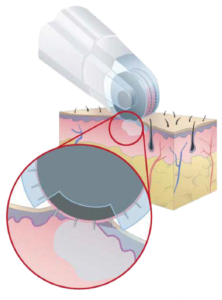 Dermafrac